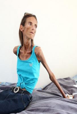 Skinniest Woman In The World; Valeria Levitina | Gist&Rhymes